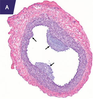 Vascular gene therapy with apolipoprotein (apo) A-I reduces atherosclerosis.