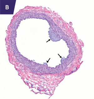 Section of rabbit carotid artery treated with apo A-I-expressing vector.