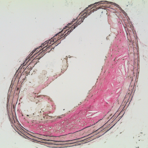 The urokinase (uPA)/plasminogen system and vascular disease