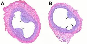 Vascular gene therapy 