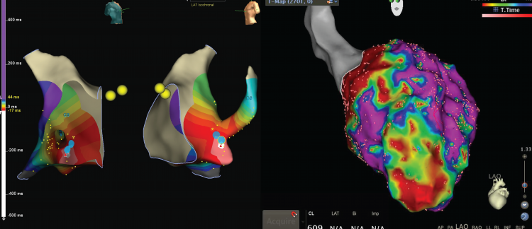 Cardiac Electrophysiology