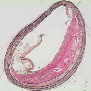 Section of innominate artery shows plaque development (right) with rupture (arrowhead) at edge of fibrous cap.