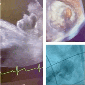 Cardiac Electrophysiology