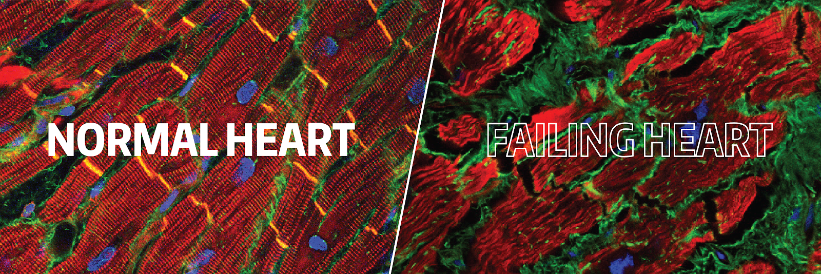 Normal heart vs failing heart imaging